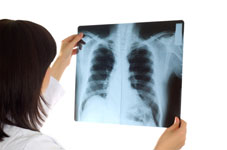 Cancer du poumon : Chirurgie - LeCancer.fr
