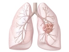 lungenkrebs