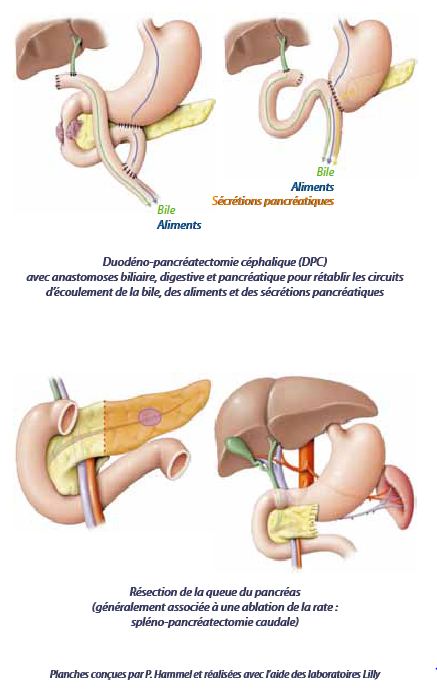 Cancer du pancréas : Chirurgie - LeCancer.fr